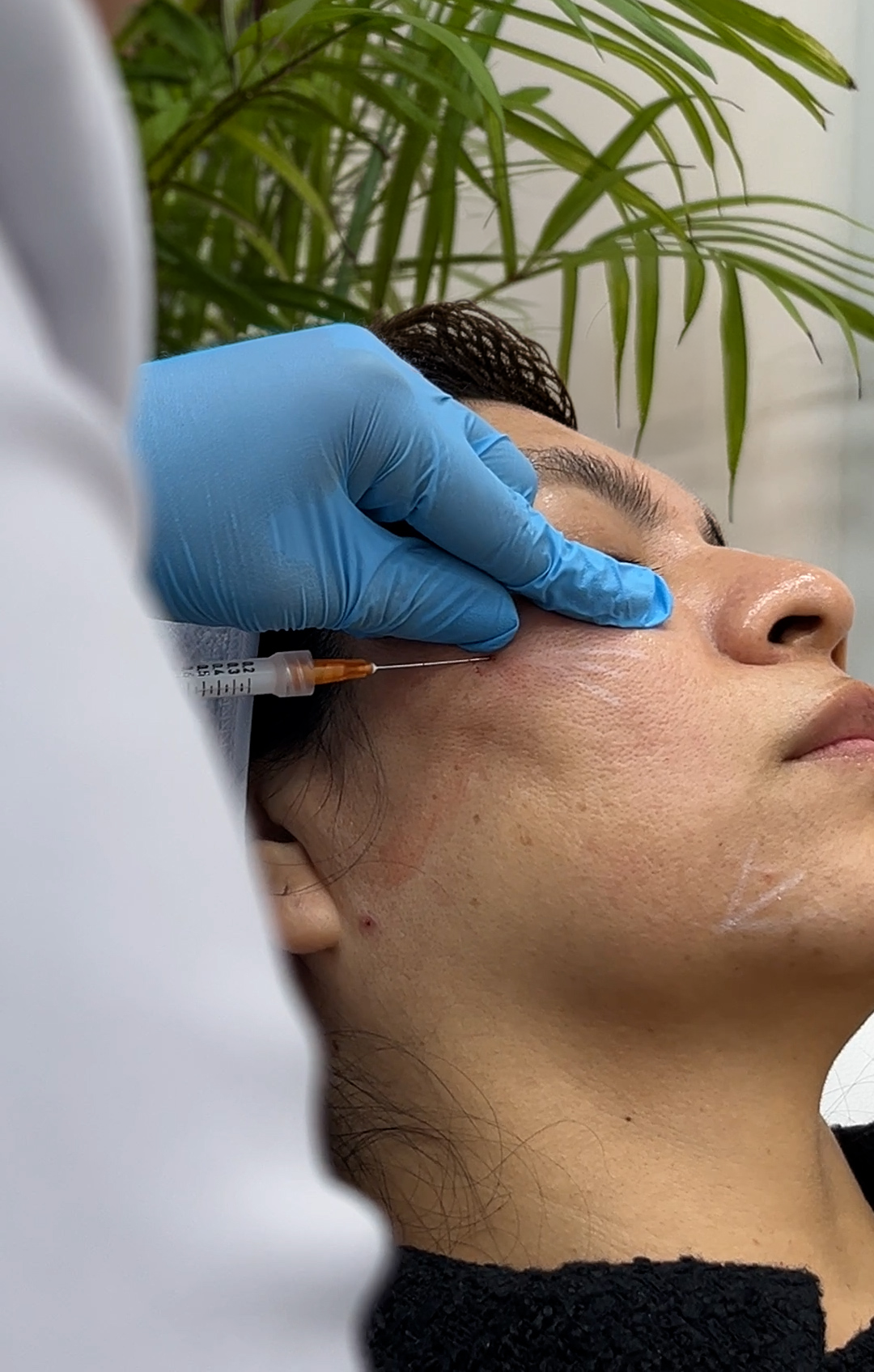 Bioestimuladores (Ellansé, Radiesse, Profhilo)